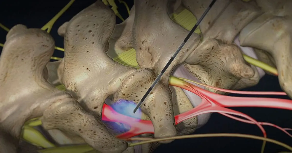 Epidural Steroid Injections 1